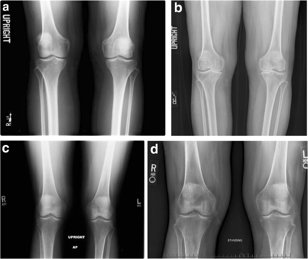 Knee Osteoarthritis Classification