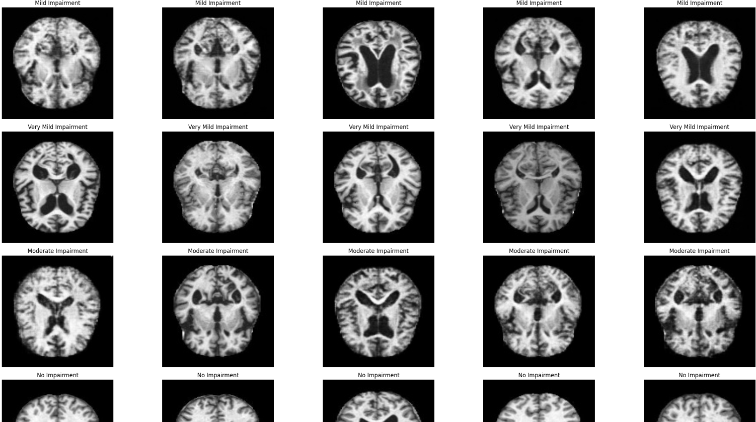 Alzheimer's Detection and Multi-Class Classification Using CNN and Pretrained Model
