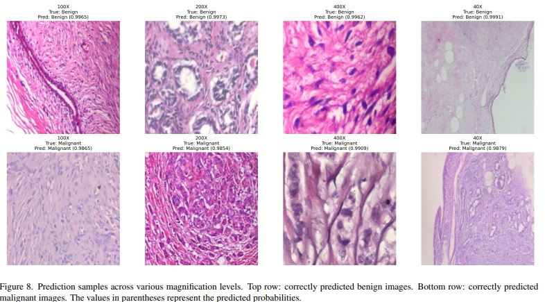 (BreaKHis Dataset)Histopatholagical images Binary Classification for Breast Cancer Detection