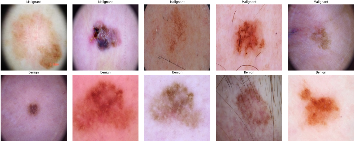 Skin Cancer Detection Using Transfer Learning